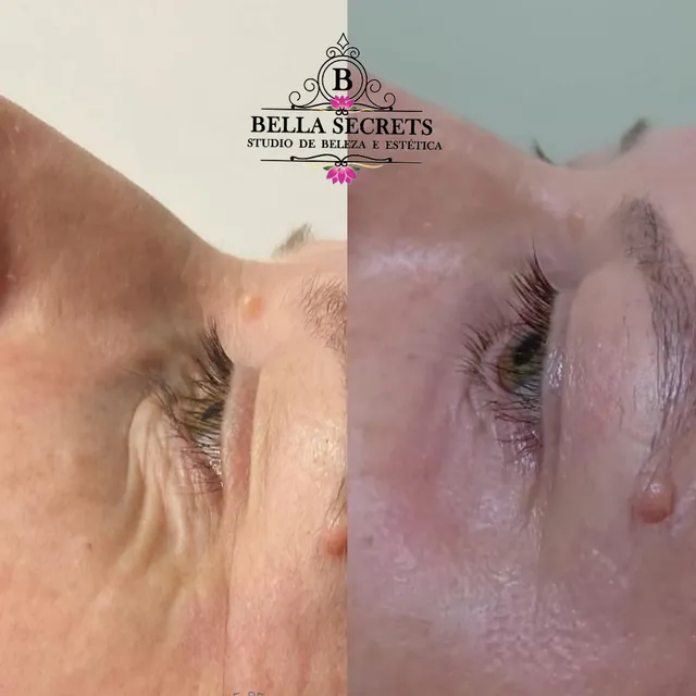 Rugas & lipo de papada